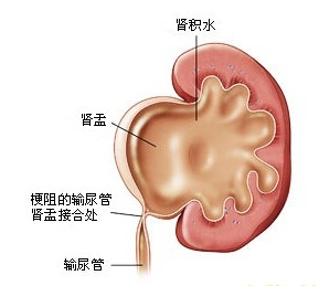 中医名积水(主症是下肢水肿)，类似于仙丰制作的大禹69号